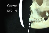 Can Facial Bone Structure Predict Left-Handedness?