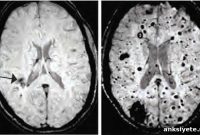 Study Finds Gut Bacteria Linked to Brain Blood Vessel Lesions