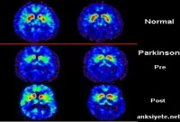 Discovery of New Molecular Pathway Linked to Parkinson’s Disease