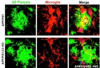 Immune System Links to Alzheimer’s Uncovered