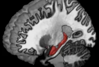 Hippocampus Links Slower Walking to Cognitive Decline