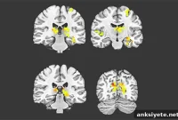 Stiff Arteries and Reduced Brain Blood Flow Predict Dementia