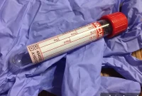 Early Blood Test Detects Treatable Brain Metastases