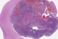 Study Identifies Gene Combinations Driving Glioblastoma