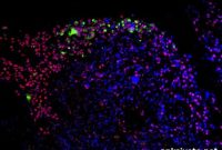 Zika Virus Shows Promise as Brain Cancer Treatment