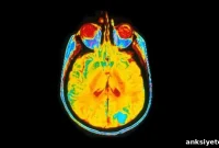 Study Reveals 10 Distinct Diseases in Childhood Brain Tumors