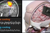 Brain Cooling Simulation May Lead to New Epilepsy Treatment