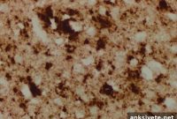 Prion Protein Found in Skin of CJD Patients