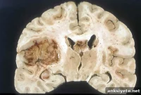 New Cancer Drug Begins Clinical Trial in Brain Tumor Patients