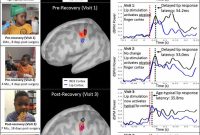 Child’s Brain Rewires After Double Hand Transplant