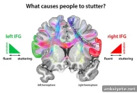 How Brain Stop Signals Interrupt Speech in Stuttering