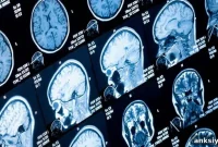 Researchers Identify Brainstem Changes in Parkinson’s Disease