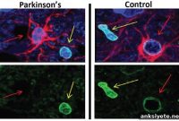 Novel Therapy Targets Parkinson’s Disease Progression
