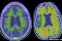 Alzheimer’s Drug Fails to Help in Major Clinical Trial