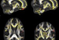 Low Fitness Tied to Weaker Brain White Matter and Dementia Risk