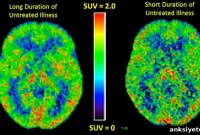 How Depression Alters the Brain Over Time