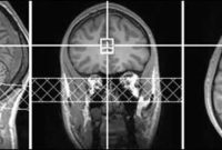 ADHD Medication Raises Brain Glutamate, Improves Mood in Adults