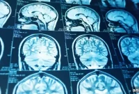 Study Finds Known Stroke Risk Genes Have Tripled