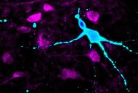 Neurons in Severe Obesity Show Altered Appetite Hormone Response