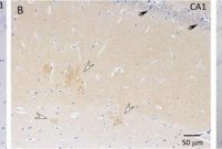 Novel Model Reveals Key Insights into Alzheimer’s Research