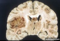 Researchers Uncover Achilles’ Heel in Brain Cancer
