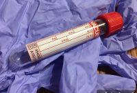 New Metabolic Blood Test May Speed Up Autism Diagnosis
