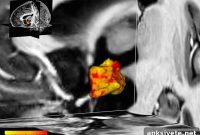 Stress-Regulating Brain Region Larger in People With Depression