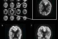 AI Predicts Alzheimer’s Years Before Clinical Diagnosis