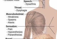 New Clues: What Triggers Multiple Sclerosis and How It Progresses