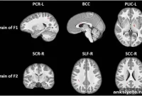 Study Finds Youth Football Alters Brain Nerve Fibers