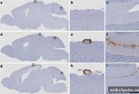 Discontinued Treatments Spread Alzheimer’s Protein to Patients