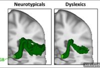 Understanding Developmental Dyslexia: Symptoms and Support