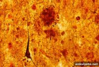 How Sleep Loss Speeds Alzheimer’s Brain Damage