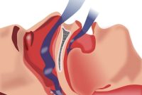 Sleep Apnea Linked to Gaps in Personal Memories