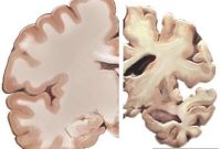 Brain Insulin Resistance Linked to Alzheimer’s Disease