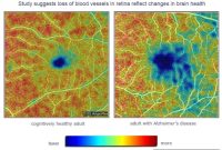 Can an Eye Exam Detect Alzheimer’s Before Symptoms?