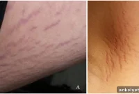 Bartonella and Sudden-Onset Teen Schizophrenia: Case Study