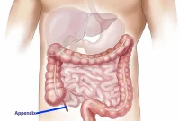 Appendectomy Linked to Increased Parkinson’s Disease Risk