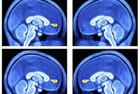 New Brain-Based Test Shows Promise for Autism Diagnosis