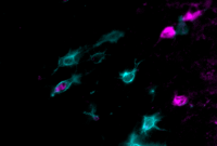 How Poor Diets Impair Memory and Brain Function