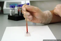 Novel Blood Test for Alzheimer’s Enters Clinical Trial