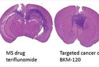 MS Drug May Improve Targeted Therapy for Glioblastoma