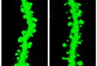 Study Finds Schizophrenia Gene Linked to Cognitive Impairment