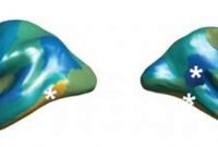 New Study Finds Greater Brain Symmetry in Autism