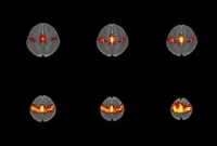 Prenatal Opioid Exposure Linked to Altered Infant Brain Function