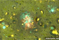 Study Links Aluminum Exposure to Familial Alzheimer’s