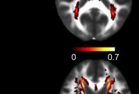 Blood Biomarker Predicts Stroke and Dementia Risk