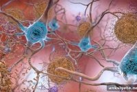 Subtle Cognitive Decline Predicts Alzheimer’s Progression