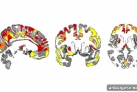 Brain Iron Linked to Cognitive Decline in Parkinson’s Disease