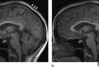 Do Long-Duration Spaceflights Reduce Astronaut Brain Volume?